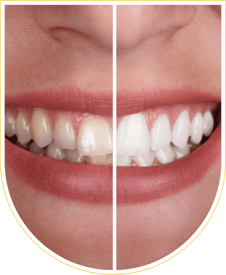 Clareamento dental em lages