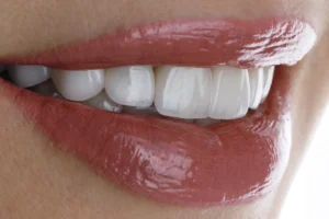 Lente de contato dental: vale a pena? Tire suas dúvidas